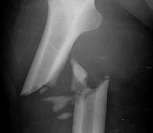 Radiografia di un femore fratturato